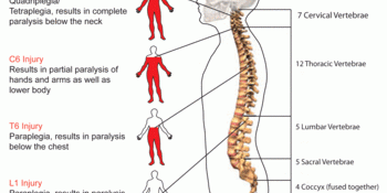 Traumatic Spinal Cord Injuries