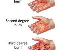 Burn Injuries as a Result of an Accident
