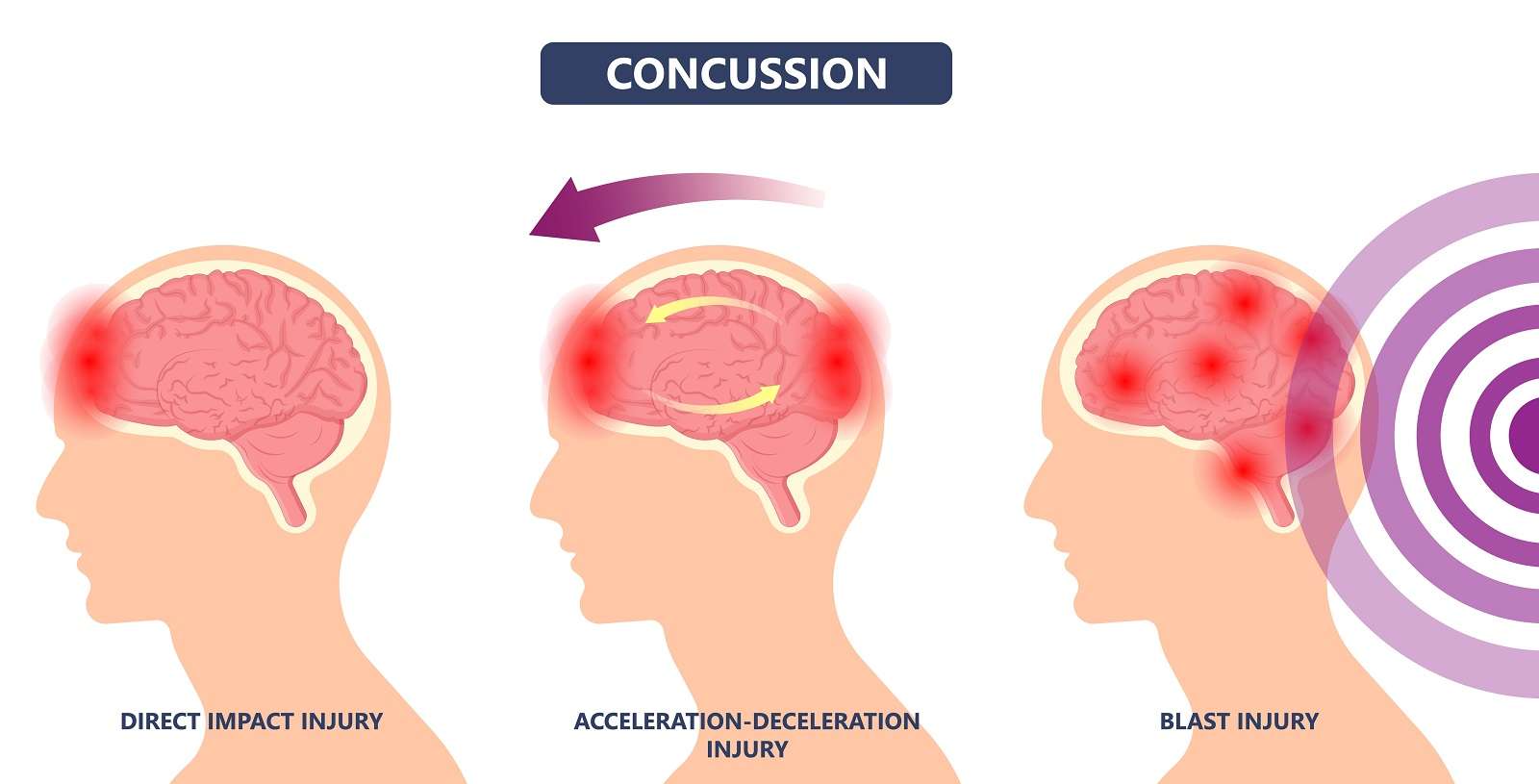 Can You Get a Concussion Without Hitting Your Head Dispelling